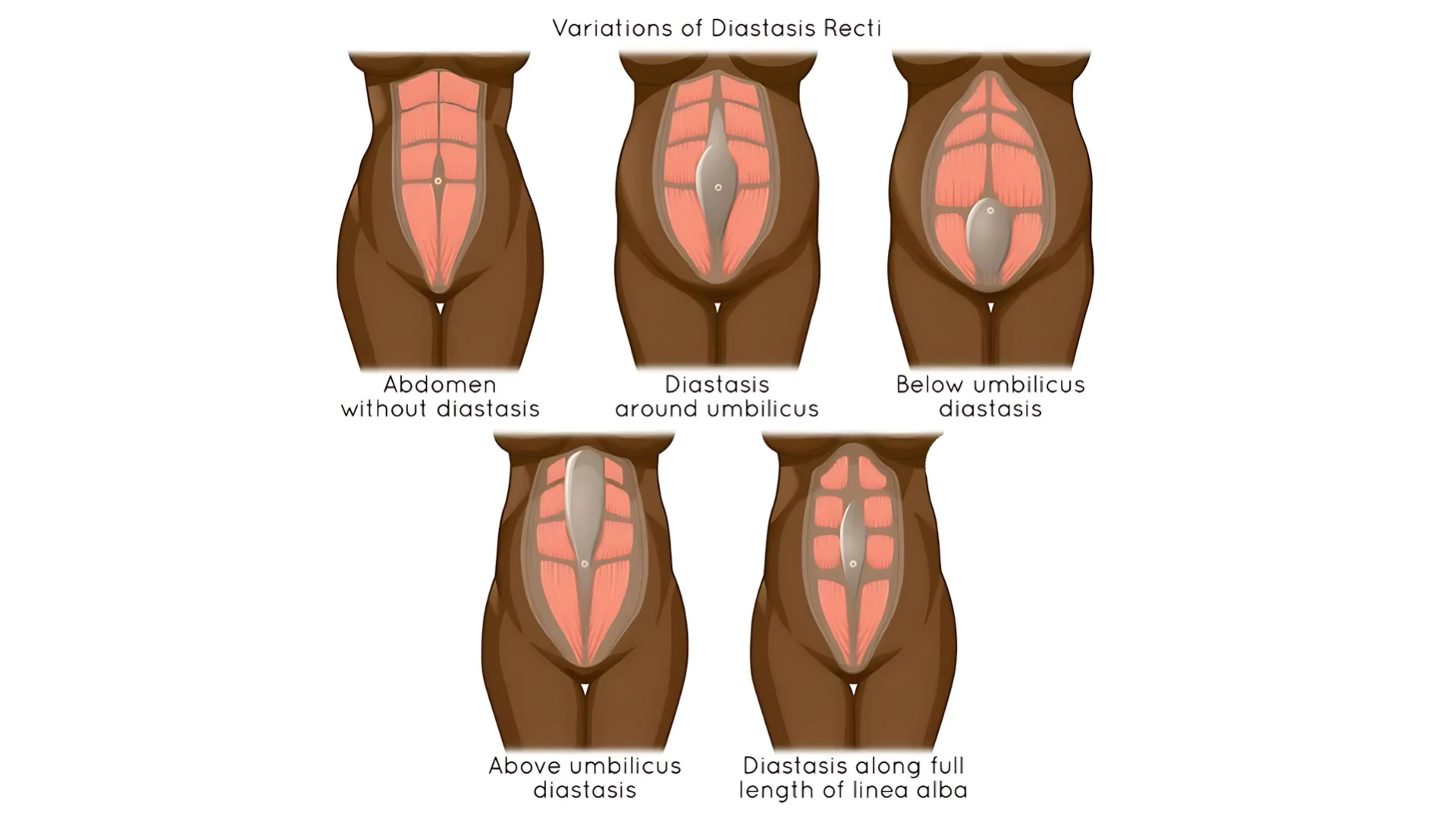 variations-of-diastasis